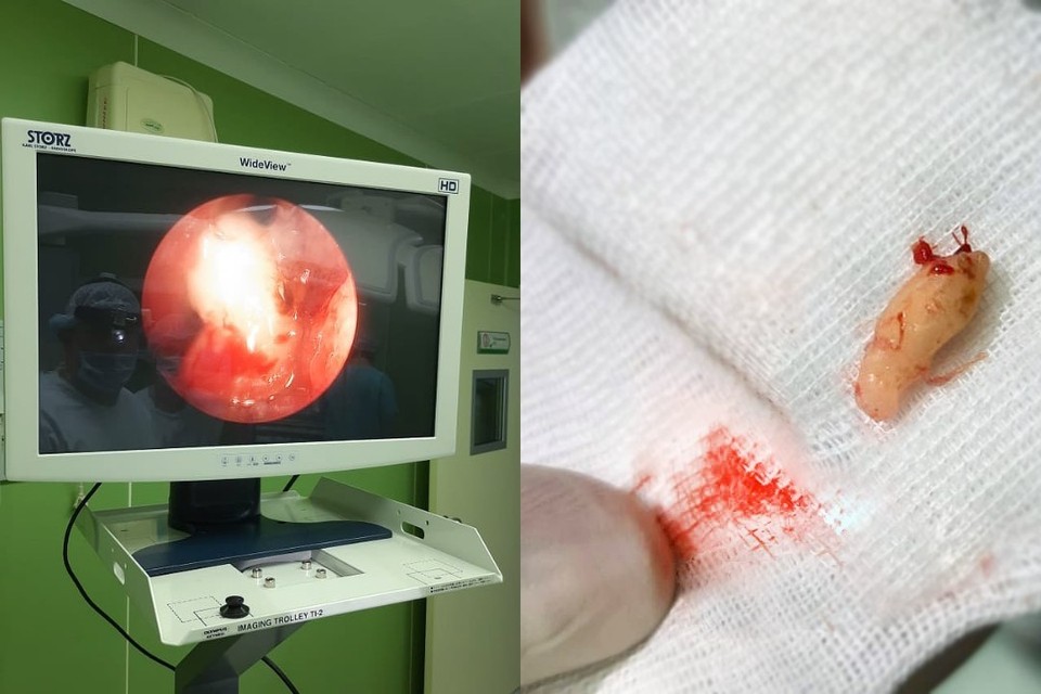 Зуб удалили из носа школьницы иркутские врачи