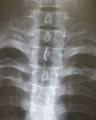 Иркутские хирурги спасли подростка, проглотившего иголку от шприца