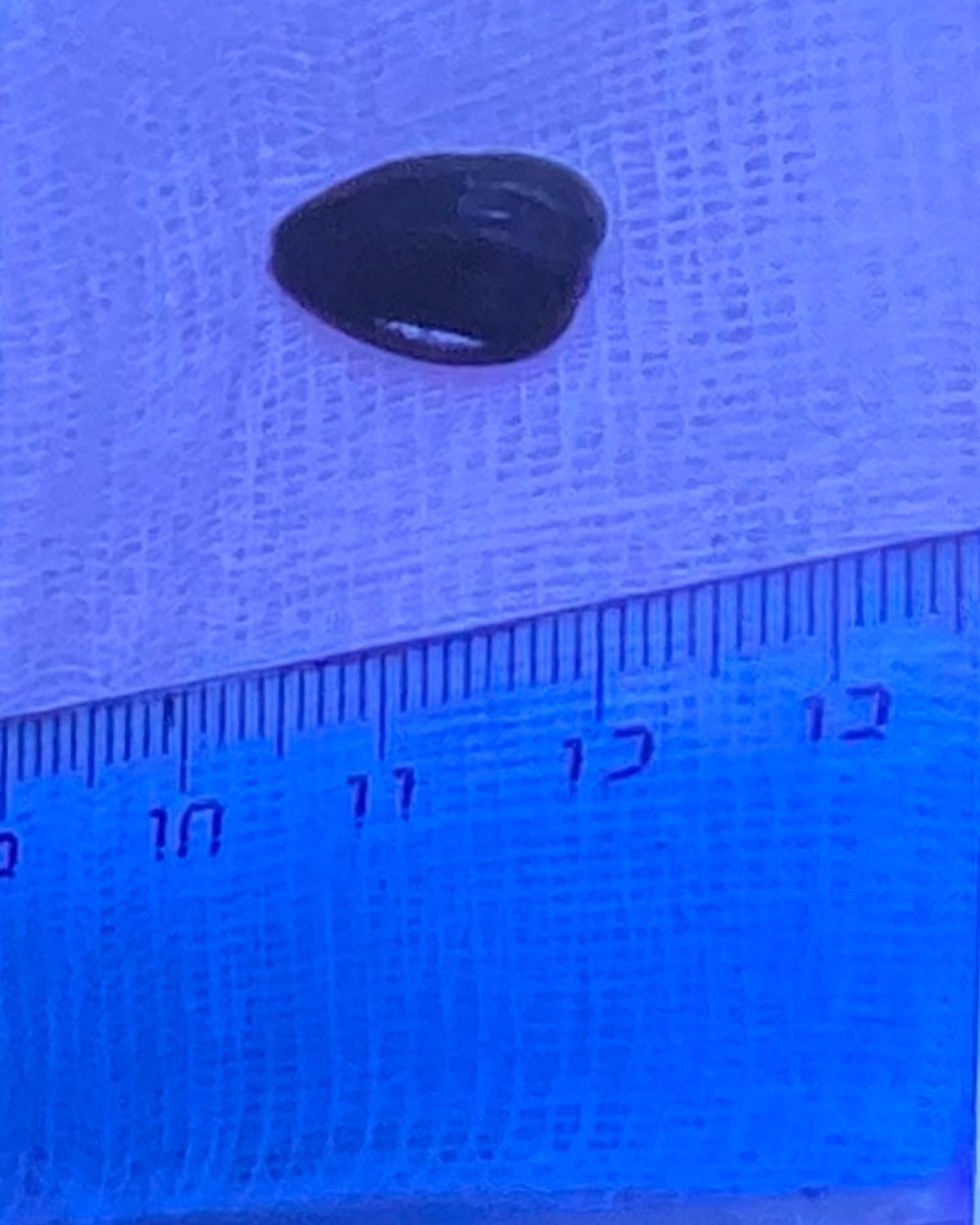 5-летнего мальчика, подавившегося семечкой, чудом спасли врачи