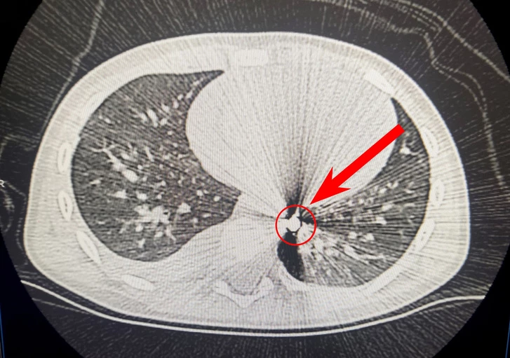 Мальчика, получившего пулю в грудь, чудом спасли врачи