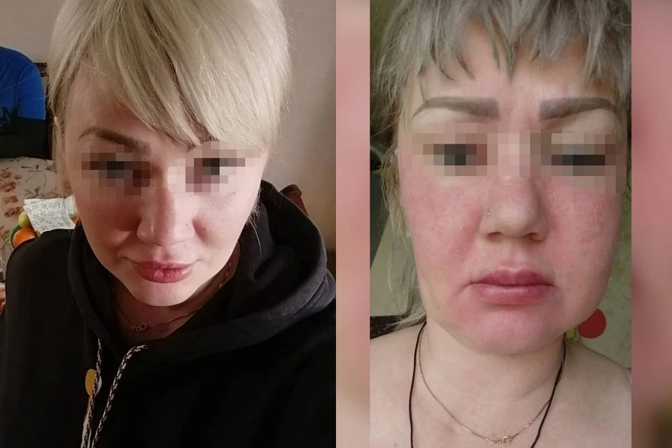 Распухшее фиолетовое лицо получила ангарчанка после «уколов красоты»