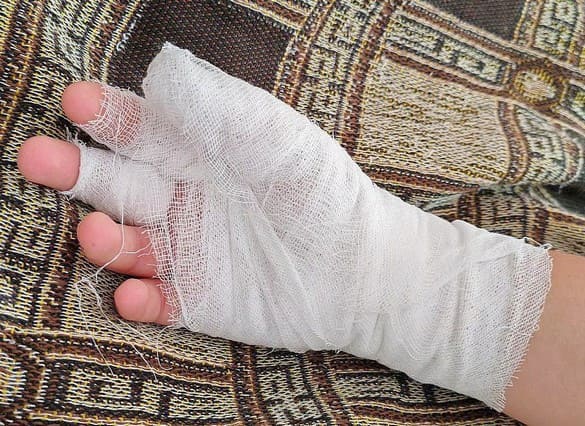 Мальчик лишился пальцев руки из-за удара током в Иркутске