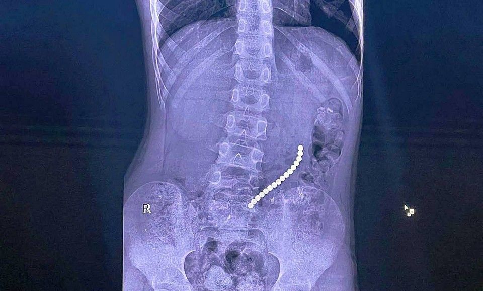 Ребенка, проглотившего 16 магнитов, спасли врачи в Иркутске