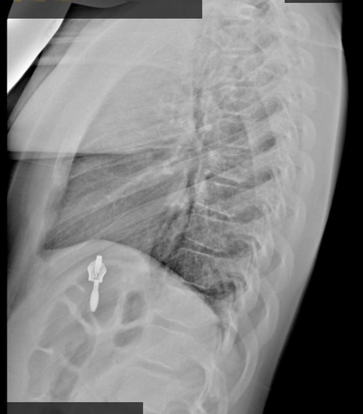 Сразу пятеро детей с переломами позвоночника поступили в Ивано-Матренинскую больницу