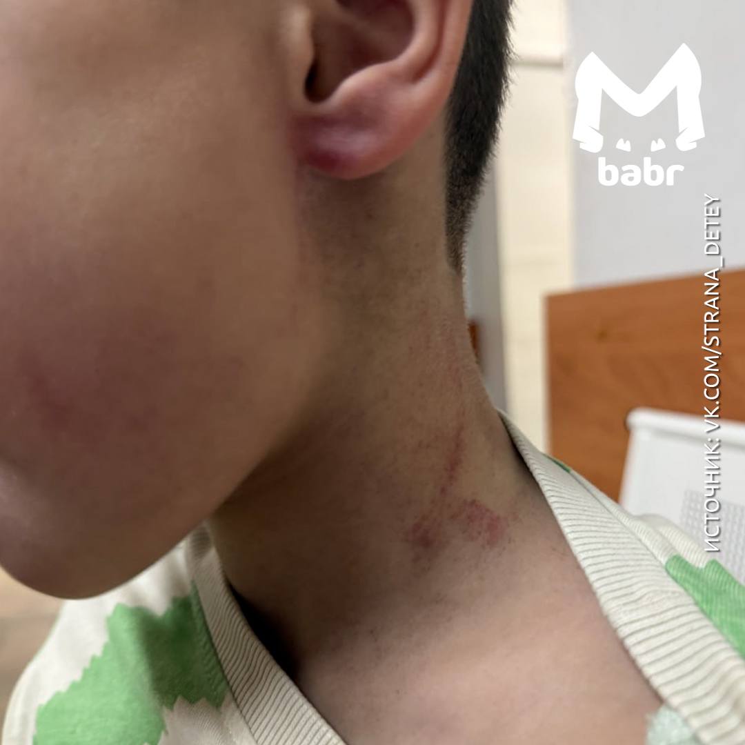 В детсаду в Молодежном тренер нанес травмы ребенку